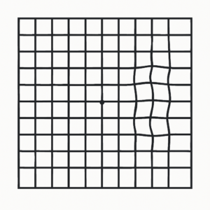 Example of an Amsler grid showing wavy line distortion, used to test for AMD symptoms.